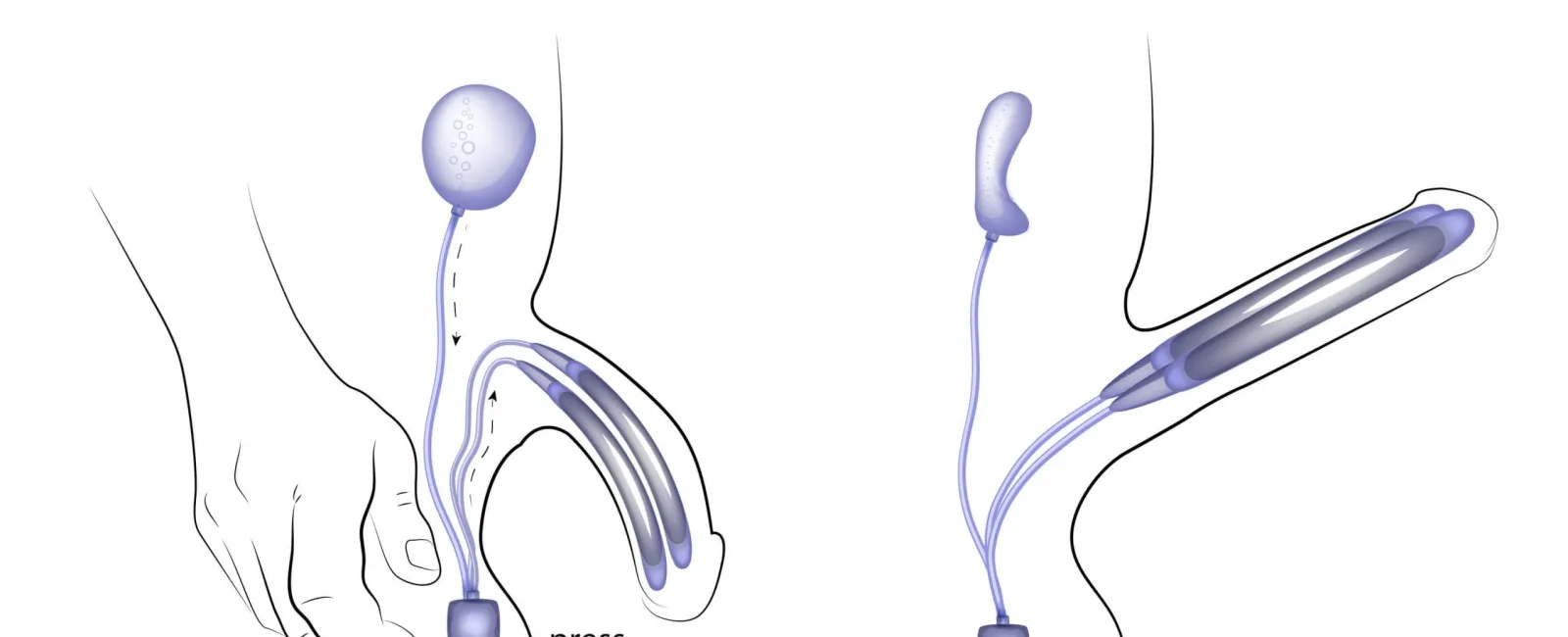 How Does A Penile Implant Work Advanced Urology