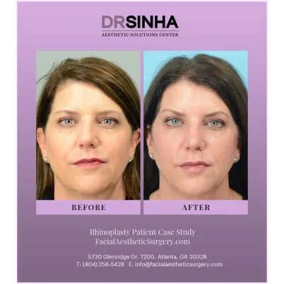 Dr. Sinha Rhinoplasty Case Study 11