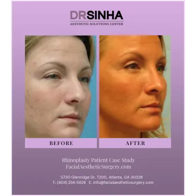 Dr. Sinha Rhinoplasty Case Study 17