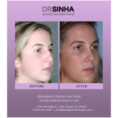 Dr. Sinha Rhinoplasty Case Study 16