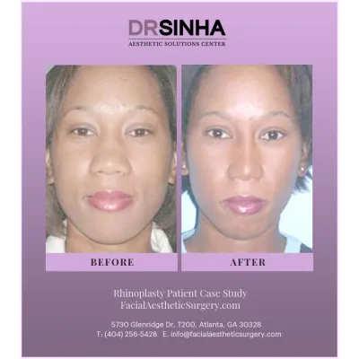 Dr. Sinha Rhinoplasty Case Study 18