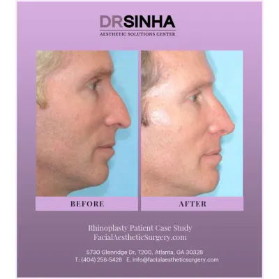 Dr. Sinha Rhinoplasty Case Study 13