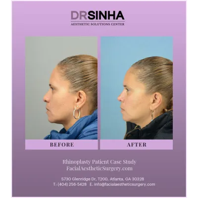 Dr. Sinha Rhinoplasty Case Study 7