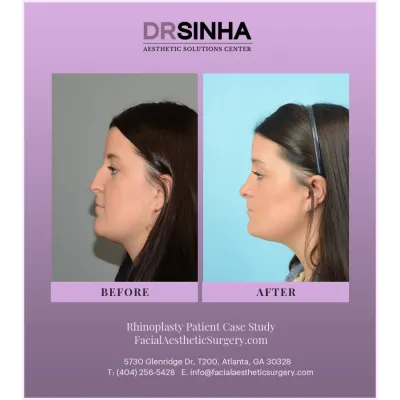 Dr. Sinha Rhinoplasty Case Study 5
