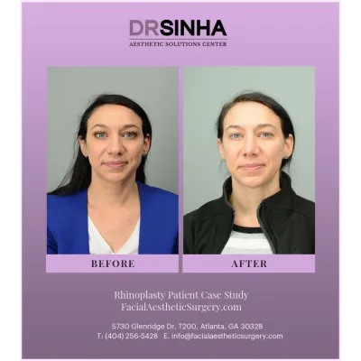 Dr. Sinha Rhinoplasty Case Study 8