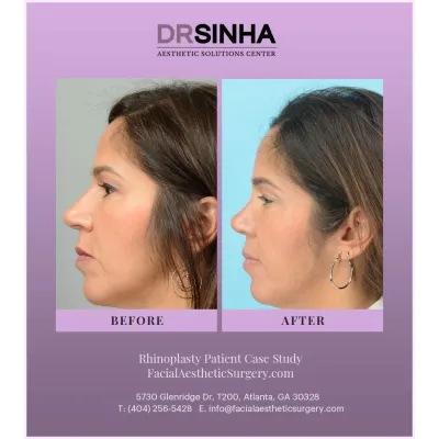 Dr. Sinha Rhinoplasty Case Study 10