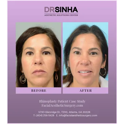 Dr. Sinha Rhinoplasty Case Study 10