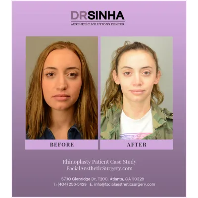 Dr. Sinha Rhinoplasty Case Study 2