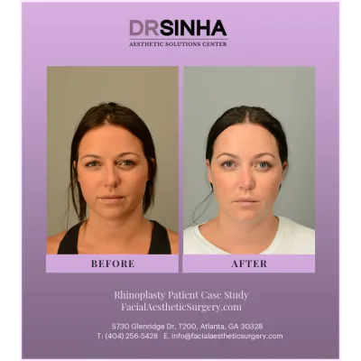 Dr. Sinha Rhinoplasty Case Study 3