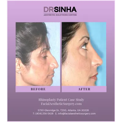 Dr. Sinha Rhinoplasty Case Study 14