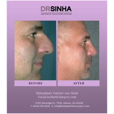 Dr. Sinha Rhinoplasty Case Study 19