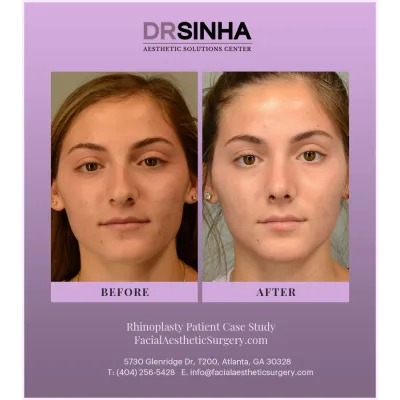 Dr. Sinha Rhinoplasty Case Study 9