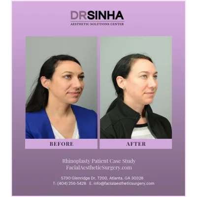 Dr. Sinha Rhinoplasty Case Study 8