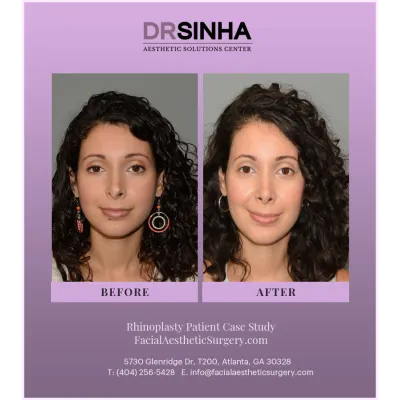 Dr. Sinha Rhinoplasty Case Study 4