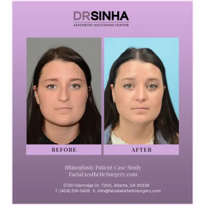 Dr. Sinha Rhinoplasty Case Study 5
