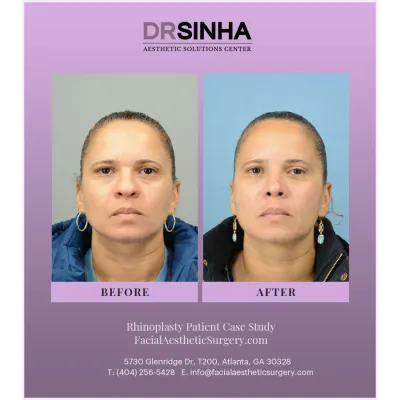 Dr. Sinha Rhinoplasty Case Study 7