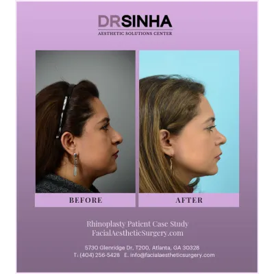 Dr. Sinha Rhinoplasty Case Study 1