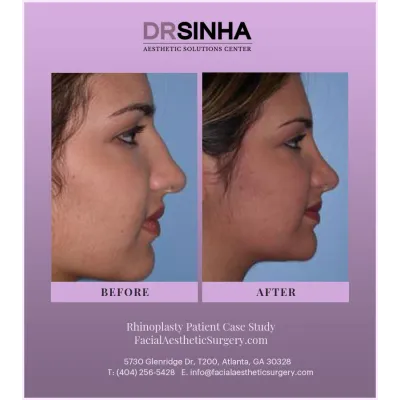 Dr. Sinha Rhinoplasty Case Study 15