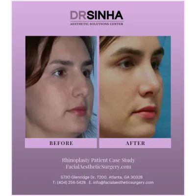 Dr. Sinha Rhinoplasty Case Study 12