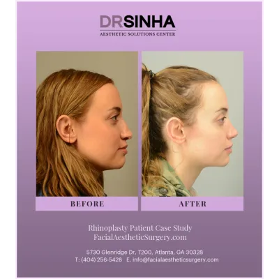 Dr. Sinha Rhinoplasty Case Study 2