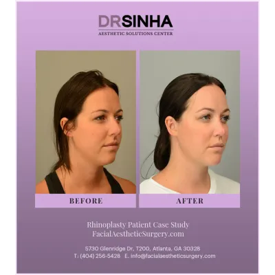 Dr. Sinha Rhinoplasty Case Study 3
