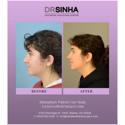 Dr. Sinha Rhinoplasty Case Study 6