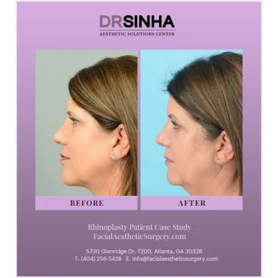 Dr. Sinha Rhinoplasty Case Study 11