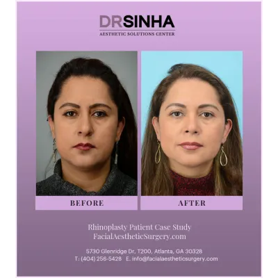 Dr. Sinha Rhinoplasty Case Study 1