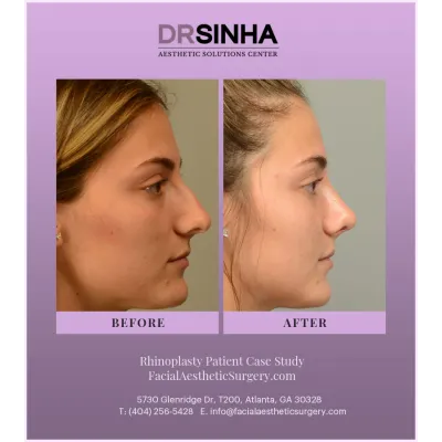 Dr. Sinha Rhinoplasty Case Study 9