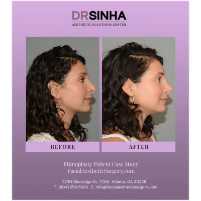 Dr. Sinha Rhinoplasty Case Study 4