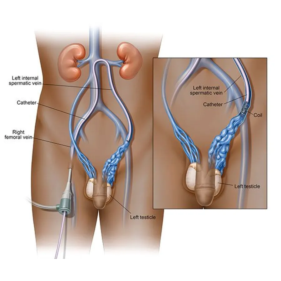 Medical illustration of catheter and coil placement in left internal spermatic vein near left testicle for varicocele treatment.