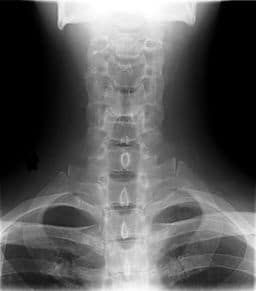 scan of a spine and neck
