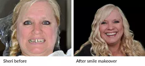 woman before after smile makeover