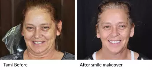 tami before after smile makeover