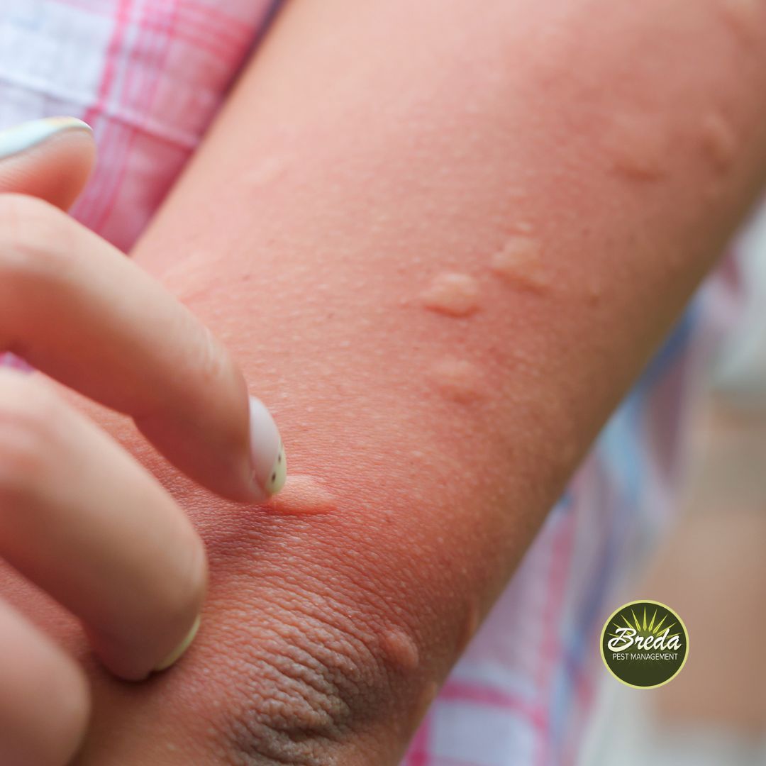 Girl scratching multiple mosquito bites on her arm