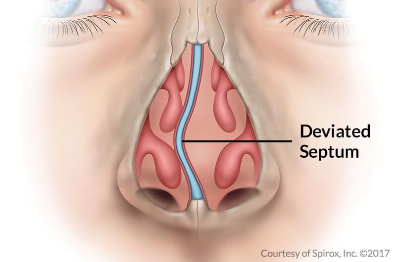 Deviated Septum