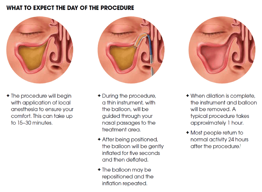 Balloon Sinuplasty: What to expect