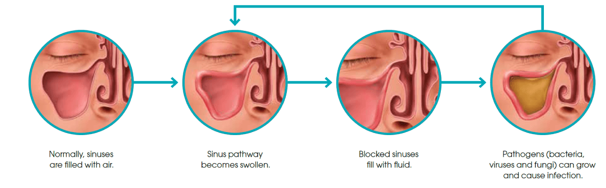 What is sinusitis?