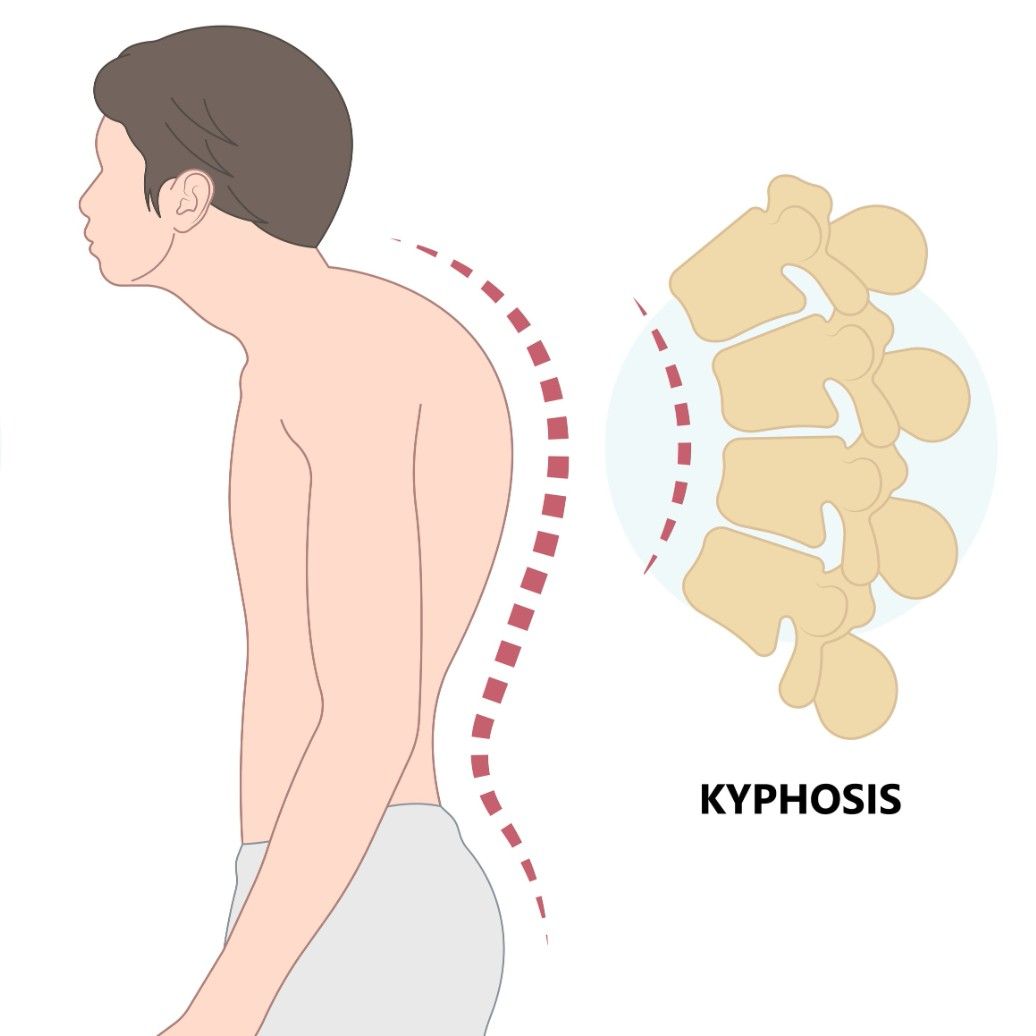 kyphosis diagram