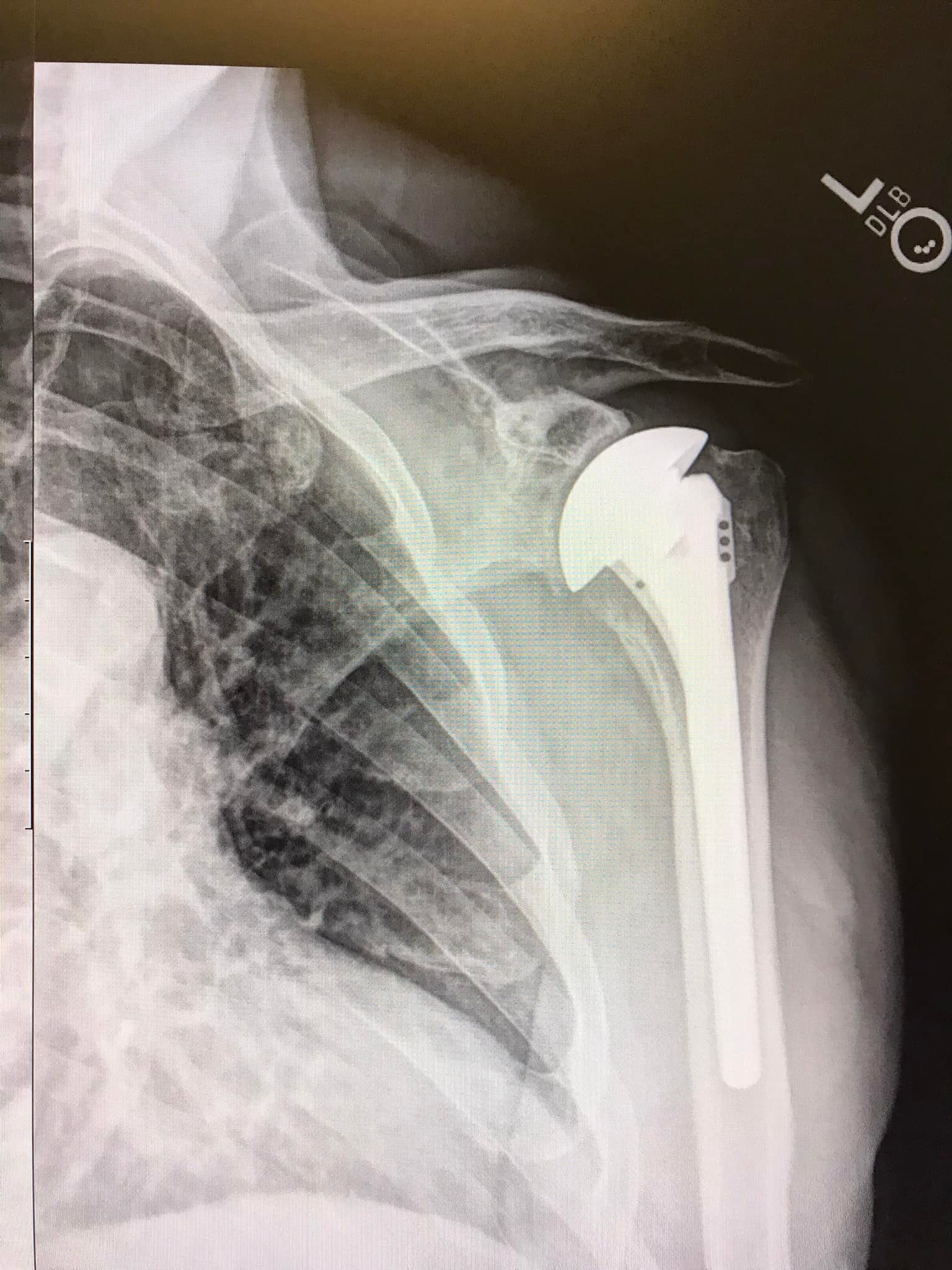 Rotator Cuff Tears  Proliance Orthopedic