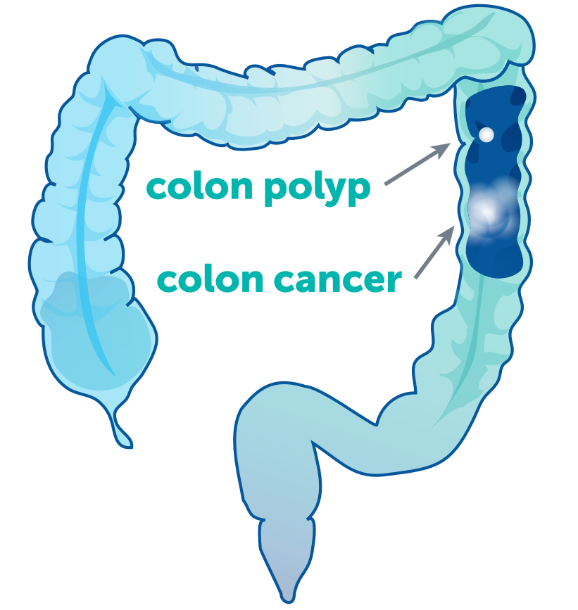 Diagram of colon labeled with 'colon polyp' and 'colon cancer'