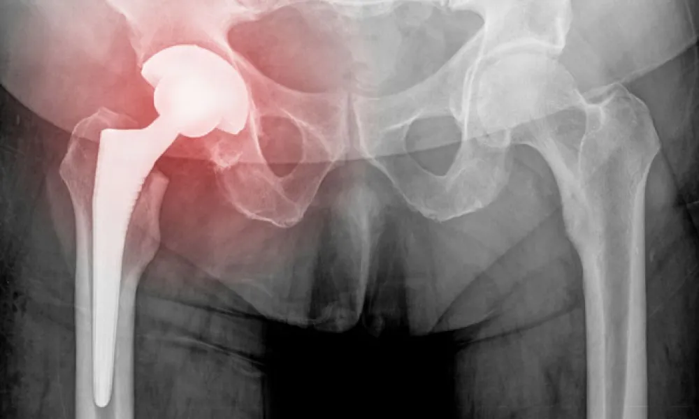 The Value of Innovation in Joint Replacement