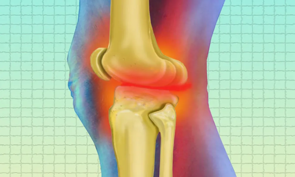 “Ideal” Limb Alignment After Knee Replacement