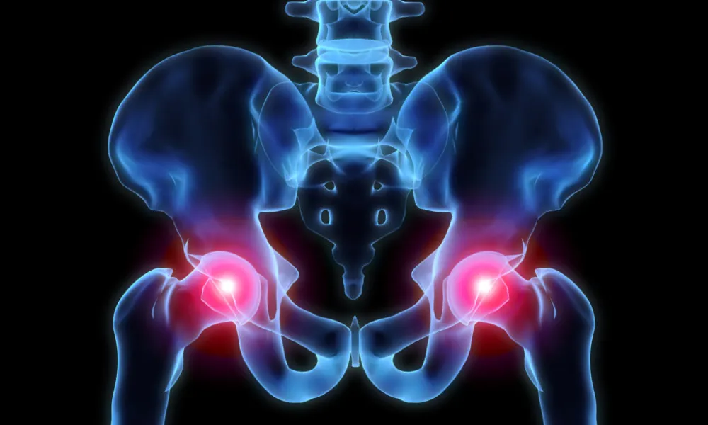 Options for Bearing Surfaces in Total Hip Replacement