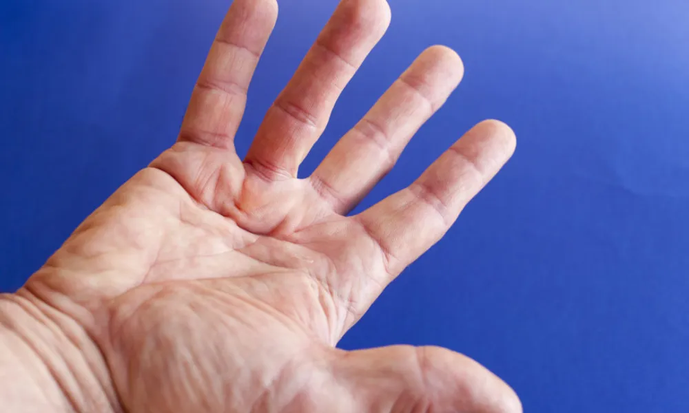 Dupuytren's Contracture