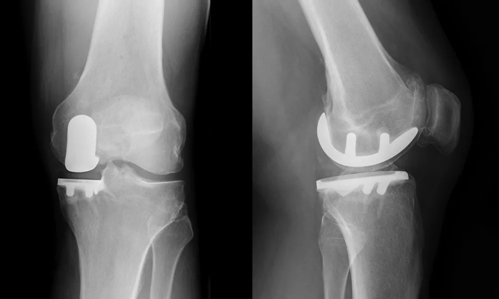 Unicompartmental or Partial Knee Replacement