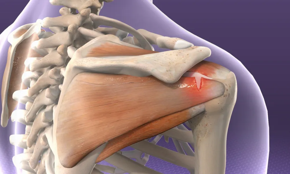 Buy Rotator Cuff Injury Explained. Including Rotator Cuff Tear