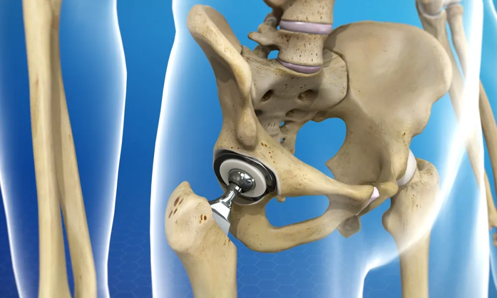Options for Surgical Approaches in Total Hip Replacement