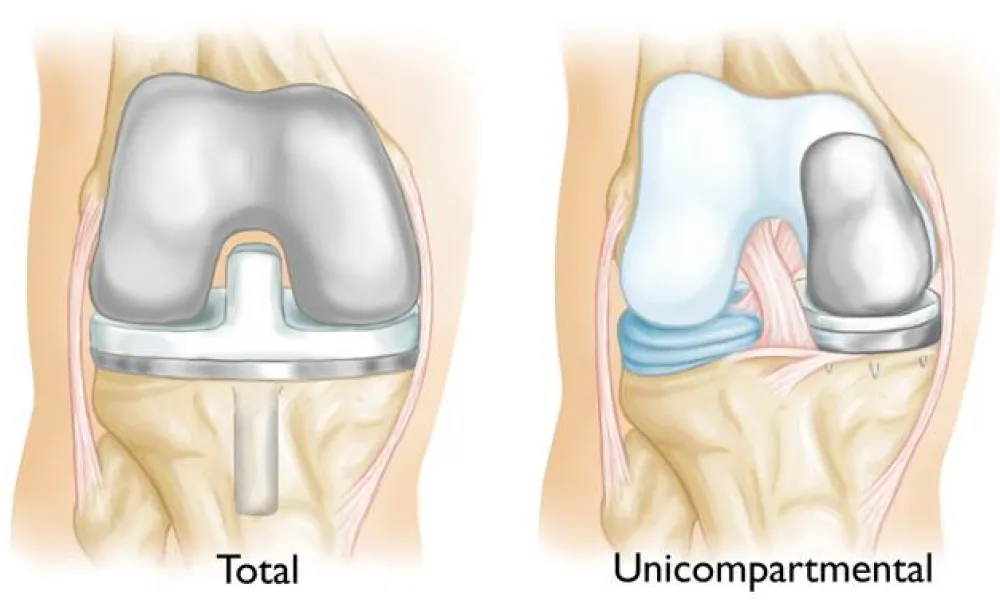 an image involving total and partial knee replacement