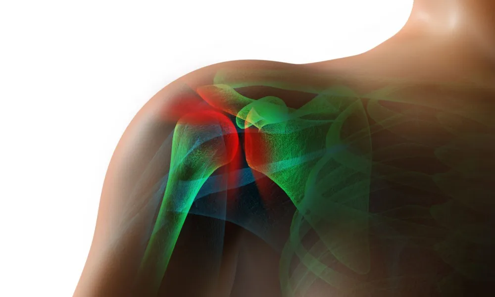 Frozen Shoulder  Proliance Orthopedic